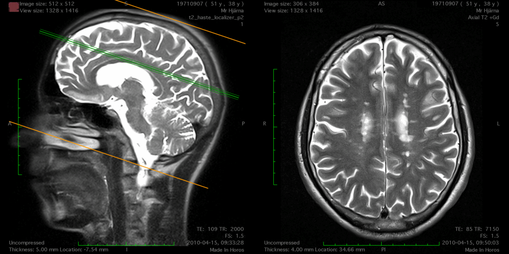 MRI skanning av en hjärna från två vinklar